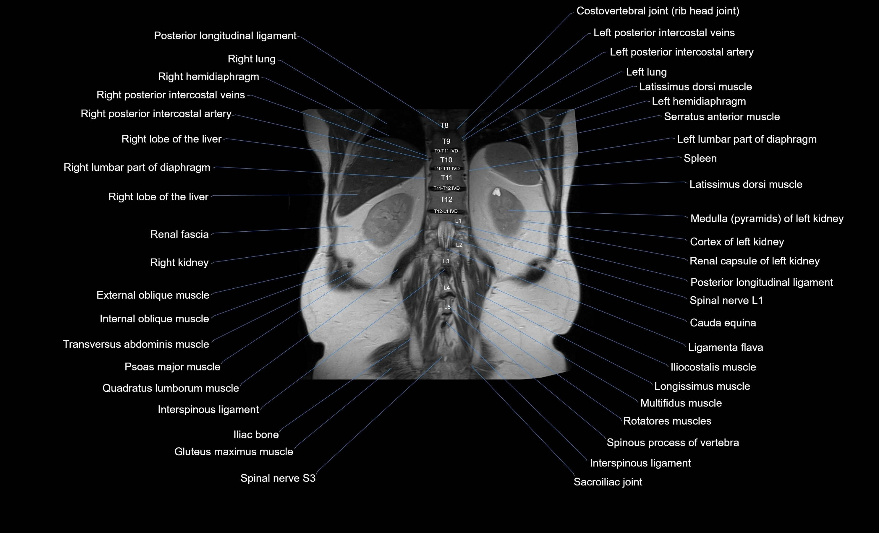 MRI Abdomen coronal labelled cross sectional anatomy radiology  image-img-00001-00046.webp